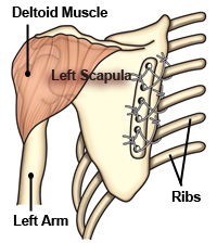 People with FSHD who have at least one strong deltoid muscle (at the top of the arm) may choose to have a surgical procedure in which the scapula (shoulder blade) is tethered to the back of the rib cage, allowing the deltoid the leverage it needs to lift the arm.