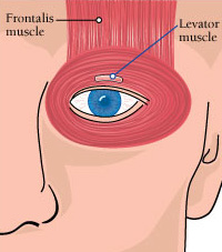 In OPMD, the levator muscle weakens, causing the upper eyelid to droop. To offset this, a surgeon can remove excess skin from the upper eyelid; tighten the levator; tighten the nearby Muller’s muscle; or attach the frontalis muscle to the eyelid.