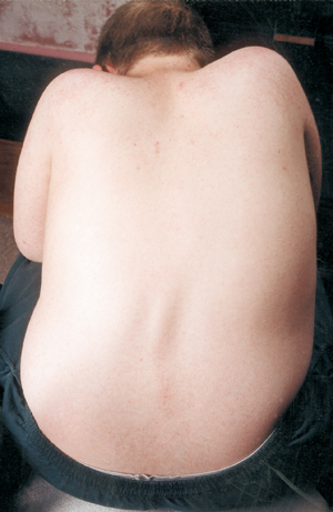 Scoliosis (spinal curvature) is a common problem in SMA and should be corrected.