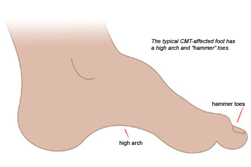 Quest - Article - Surgery Sometimes, Bracing Often, Caution Always | Muscular Dystrophy Association