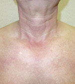 A reddish or purplish rash and scaly, rough skin are typical in dermatomyositis.