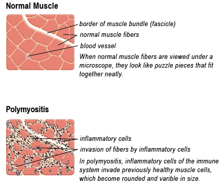 What are the symptoms of polymyositis?