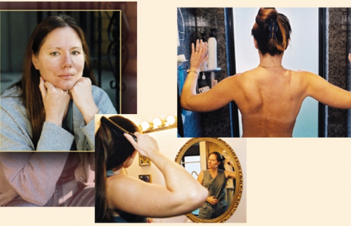 A montage with a few different pictures of Claire Walker. In the top left there's a nice portrait of her, in the middle there's a picture of her brushing her hair with one arm, and on the right there's a picture of her back, displaying her mobility after surgery