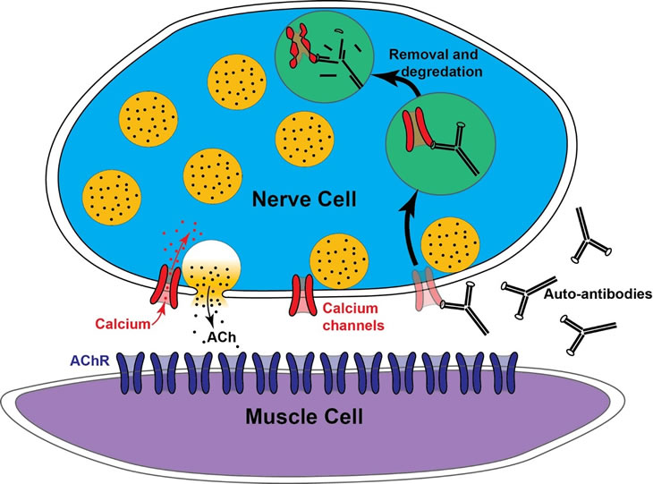 At the ending of the motor nerve, electrical activity normally opens calcium channels (red) that allow calcium ions to enter the nerve ending and trigger the release of acetylcholine (ACh) contained in vesicles (yellow circles). LEMS occurs when the immune system makes antibodies that selectively attack calcium channels. This leads to their internalization and destruction. As a result, in LEMS there are fewer calcium channels at nerve endings, leading to a reduction in ACh release and resulting muscle weakness.