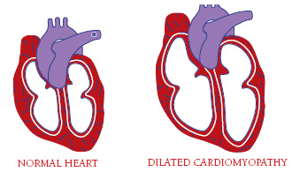 A floppy, dilated heart can’t pump effectively.