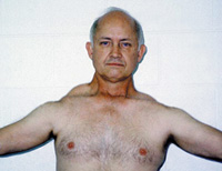 Because of weakness in the shoulders and back, muscles that normally do not show from the front are visible in FSHD.