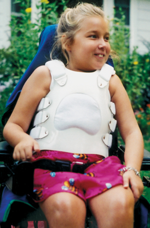 This girl with SMA type 2 used a back brace as a toddler. At 9, she underwent surgery to correct a spinal curvature and wore a temporary brace while recovering from surgery.