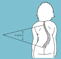 To determine the Cobb angle, lines are drawn parallel with the surface of the top and bottom tilted vertebrae, and the angle of their intersection is measured.