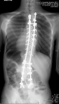 Segmental spinal fixation with dual rods, shown from the back. The surgeon used pedicle screws to secure the rods to the upper spine, a combination of screws and wires in the mid-spine, and pedicle screws for the lower spine and pelvis. 