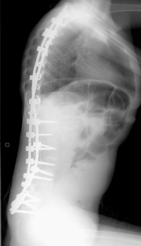 Segmental spinal fixation, shown from the side. In this example, dual rods have been fixed to the spine at multiple levels with a combination of hooks, screws and wires. (X-ray photos courtesy of Brian Snyder.)