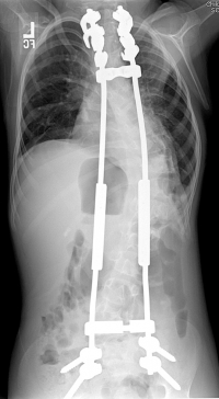 Growing rods in a young child, shown from the front. These rods span the length of the entire spine, are secured with screws to the upper spine and pelvis, and have adjustable-length rods in between, to allow for growth. Multiple surgical procedures to lengthen the rods are necessary. 