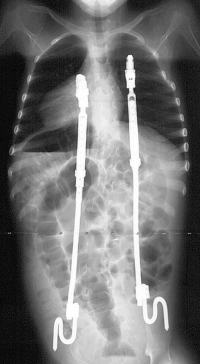 Two VEPTR devices in a growing child, shown from the front. The VEPTRs are secured to the ribs at the upper ends and to the pelvis at the lower ends. As with growing rods, VEPTR length can be adjusted as the child grows. (X-ray photos courtesy of Brian Snyder.)  
