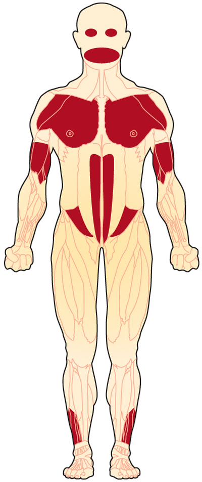 Overview | Facioscapulohumeral Muscular Dystrophy | MDA