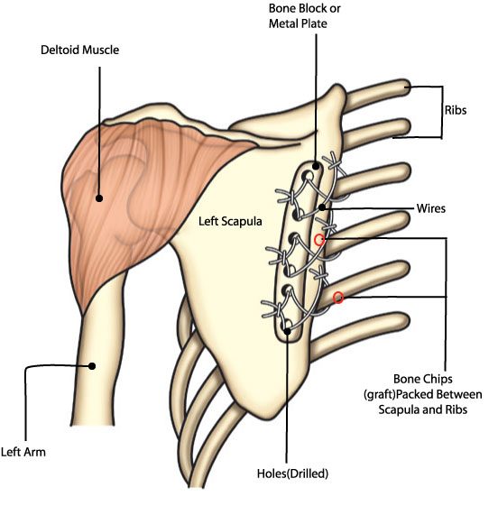 St. Louis surgeon J. David Thompson uses a tension band wiring technique with one or two bone blocks to attach the scapula to the ribs. Chicago surgeon Irwin Siegel and colleagues use a metal plate in place of the bone block(s).