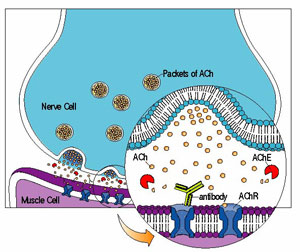 Myasthenia gravis occurs when the immune system makes antibodies that destroy the ACh receptor (AChR), a docking site for the nerve chemical acetylcholine (ACh). Some treatments block acetylcholinesterase (AChE), an enzyme that breaks down ACh, while others target the immune system.