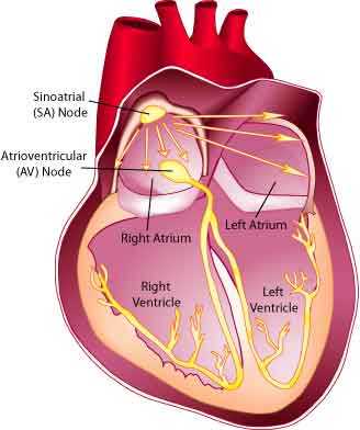 The heart’s normal pacemaker is the sinoatrial (SA) node, which sends impulses to the atria and to the atrioventricular (AV) node, from which they’re relayed to the ventricles. In Emery-Dreifuss MD, the SA node often fails to set the heart’s pace, resulting in very fast, nonfunctional atrial beats or in paralyzed atria. The AV node or cells even lower in the heart can take over, but the resulting heart rate is dangerously low.