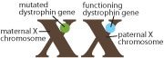 A girl inherits two X chromosomes, one from her mother (the maternal X) and one from her father (the paternal X). If she inherits a mutated dystrophin gene (green) on either X chromosome, the functioning dystrophin gene (blue) on the other chromosome is usually sufficient to prevent DMD symptoms.