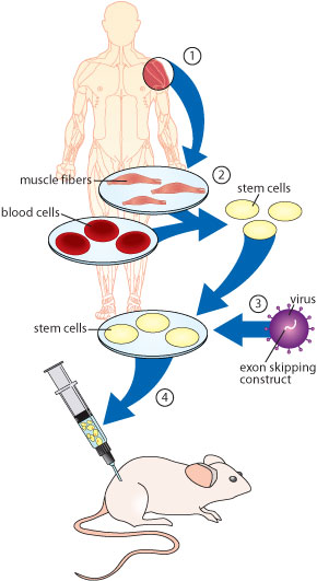 Torrente, Garcia and colleagues 1) took muscle and blood samples from people with DMD; 2) extracted stem cells from the samples; 3) corrected the cells’ dystrophin genes by giving them an exon-skipping construct inside a viral shell; and 4) injected the corrected cells into DMD-affected mice.