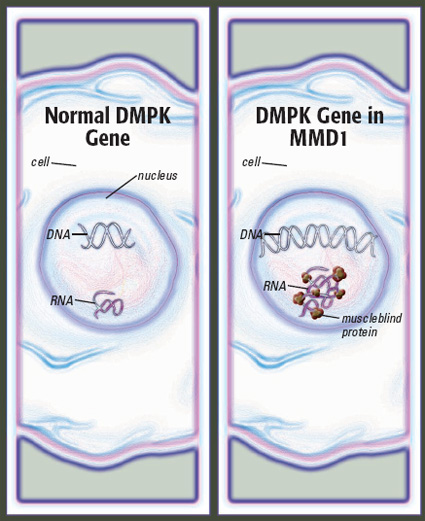 In most people, the DMPK gene has between five and 37 repeated chemical sequences, and so does the RNA that’s made from the DNA. The RNA is small enough to exit the cell’s nucleus. In an MMD1-affected cell, the DMPK gene has hundreds or even thousands more chemical sequences than average. It’s longer than usual, as is the RNA that’s made from it. The long RNA can ensnare and disable various other proteins, such as muscleblind.