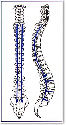 Luque rods hold the spine in place while the vertebrae fuse.