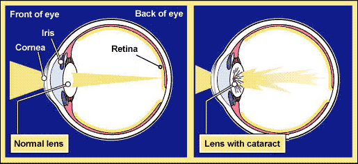 The eye receives light through the pupil, a hole in the colored part of the eye, the iris. The cornea, which covers the pupil like the glass over a watch face, helps focus the light, as does the lens, just in back of the pupil. Drying and damage to the cornea can result when the eye doesn't close properly. A cataract can occur in myotonic dystrophy or with prolonged use of corticosteroids. Abnormalities in the retina, the "screen" onto which images are projected, occur in some mitochondrial disorders.