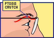 Ptosis crutch eyeglasses can help compensate for weak levator muscles as long as they're not used for prolonged periods.