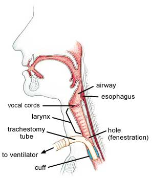 Deflating the tracheostomy cuff allows air to flow upward toward the vocal cords, making speech possible. Additional techniques, such as speaking valves, which block the exit of air through the trach tube during speech, and holes in the top of the trach tube (fenestrations), can also be employed.