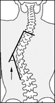 Measuring the Curve Spinal curvatures are usually measured in terms of the Cobb angle. To compute the Cobb angle, draw two lines, one extending out from the uppermost tilted vertebra and the other from the lowermost tilted vertebra; then draw lines perpendicular to those lines, and measure the angle where they intersect.