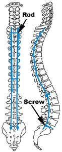 Today's spinal instrumentation systems usually employ a combination of rods (vertical supports) and screws (anchors). Jason has Moss-Miami instrumentation, with screws anchoring the rods to the back of the pelvis (sacrum).