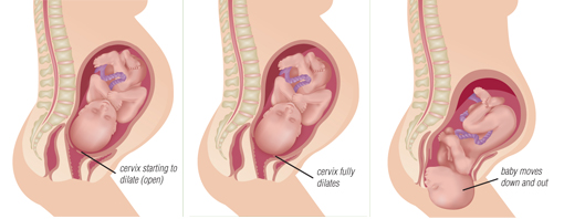 During the first stage of labor, the cervix (neck of the uterus) dilates. This stage involves the uterine muscle, which is involuntary. This type of muscle, also known as “smooth” muscle, has normal function in most neuromuscular diseases. An important exception is myotonic dystrophy, in which uterine and other smooth muscle function can be impaired.  During the second stage of labor, the uterus continues to contract, but it’s now aided by the mother’s voluntary muscle efforts to push the baby out. Voluntary muscles in the abdomen can be weak in neuromuscular disease, interfering with the expulsion of the baby and sometimes leading to an assisted vaginal or a Caesarean delivery.